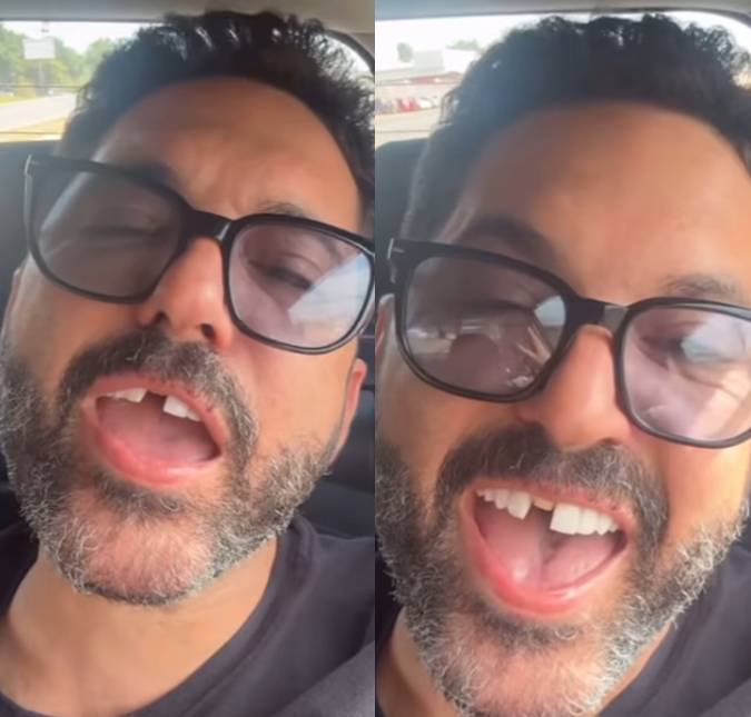 Sertanejo Edson, da dupla com Hudson, perde dente durante almoço e pede socorro nas redes sociais
